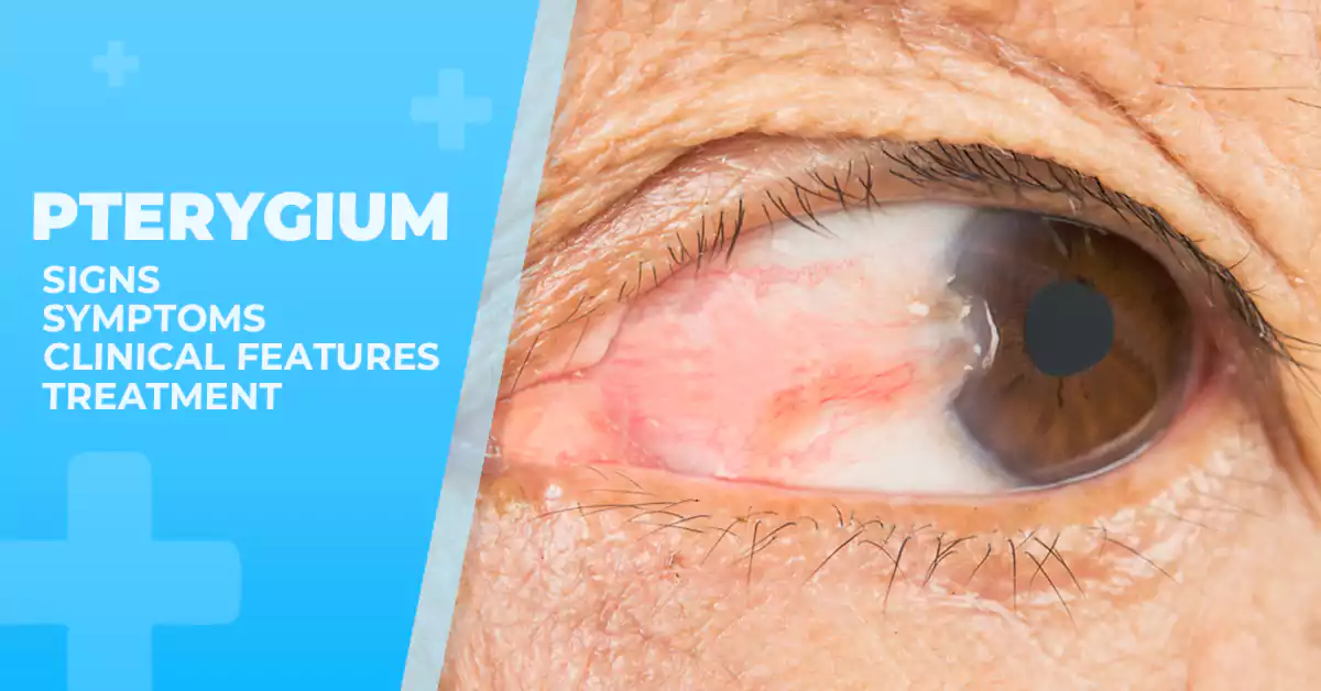 Understanding Pterygium: Causes, Symptoms, and Treatment Options